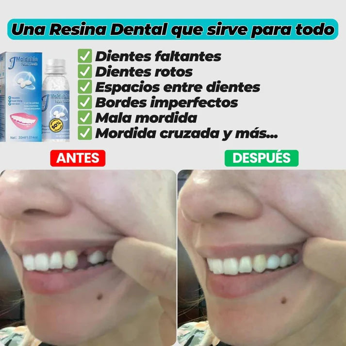 Resina Dental Moldeable 💫